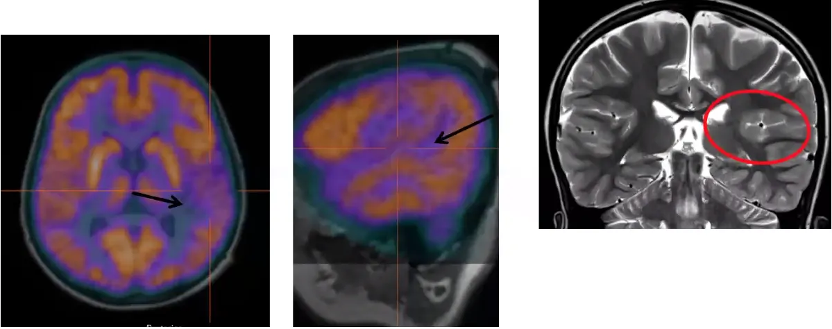 8 yr boy, focal seizures. MRI initially negative.