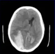 Traumatic brain injury: raised ICP O Why monitor? Intracerebral haemorrhage: increase mass effect, worse NIHSS O MCA occlusion: increased infarct volume O 