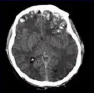 Traumatic brain injury: raised ICP O Why monitor? Intracerebral haemorrhage: increase mass effect, worse NIHSS O MCA occlusion: increased infarct volume O 