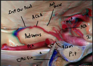 Mesial temporal lobe above the tent
