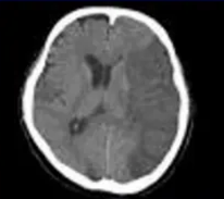 Traumatic brain injury: raised ICP O Why monitor? Intracerebral haemorrhage: increase mass effect, worse NIHSS O MCA occlusion: increased infarct volume O 