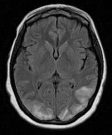 A close-up of a brain scan AI-generated content may be incorrect.