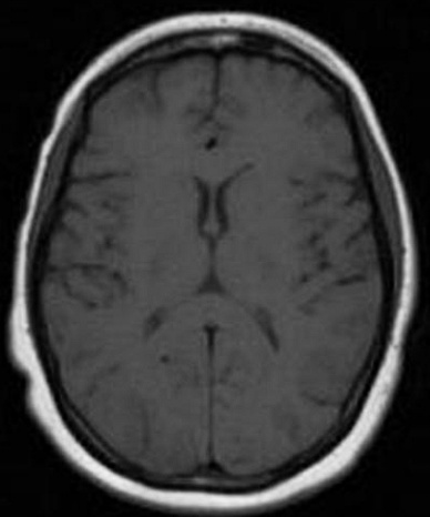 A close-up of a brain AI-generated content may be incorrect.