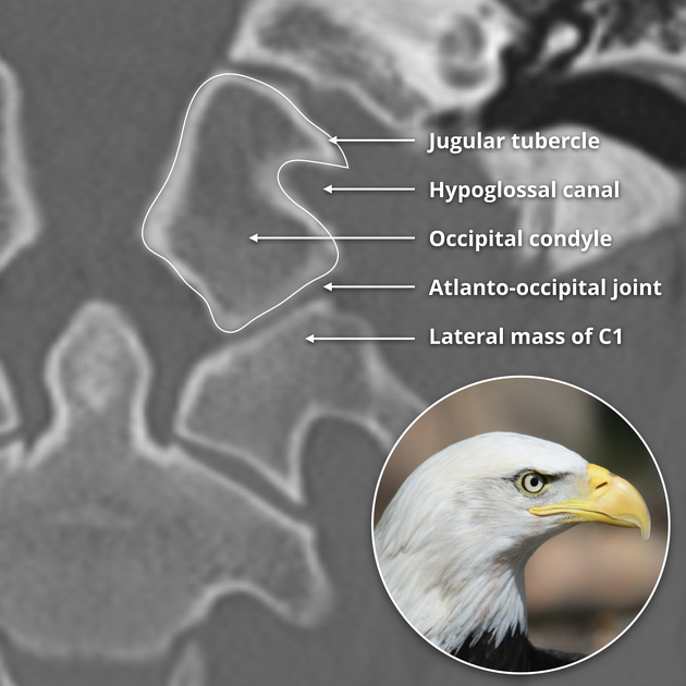 Figure 1: Eagle Sign of occipital condyle and jugular tubercule 
