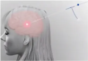 •nond street Children Laser Ablation for Epilepsy 