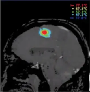 •nond street Children Laser Ablation for Epilepsy 