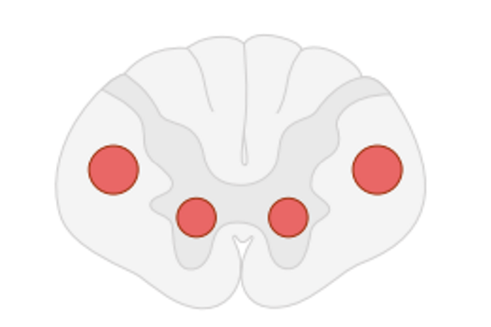 Amyotrophic lateral sclerosis