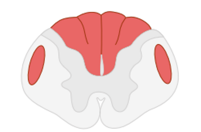 Subacute combined degeneration