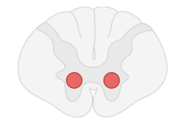 Spinal muscular atrophy