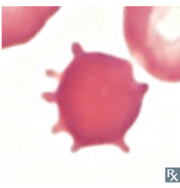 Abetalipoproteinamia