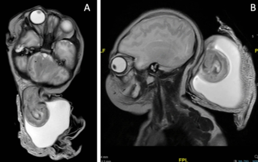 Posterior vault encephalocele.A congenital defect allowing herniation of meninges and sometimes brain tissue through the posterior skull, typically between the lambda and the foramen magnum. 