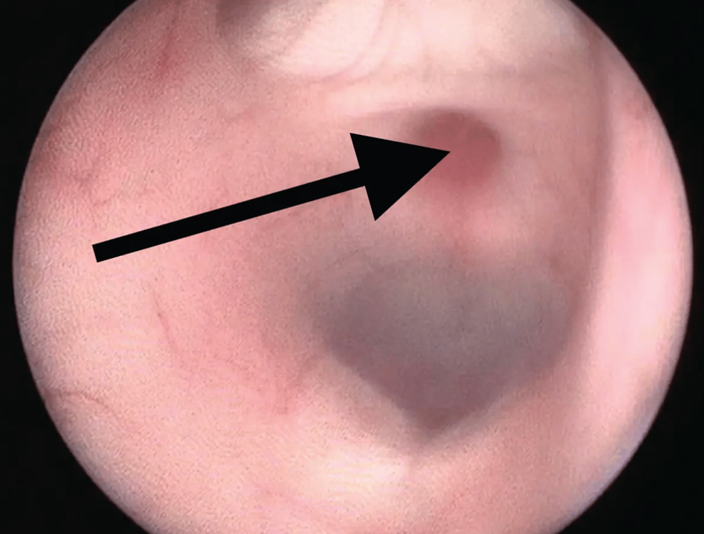 Figure 2: Arrow pointing to infundibular recess (brown/red dimple in ependyma, inferior to it is pituitary stalk). Superior to it is optic chiasm - horizontal white/yellow band.