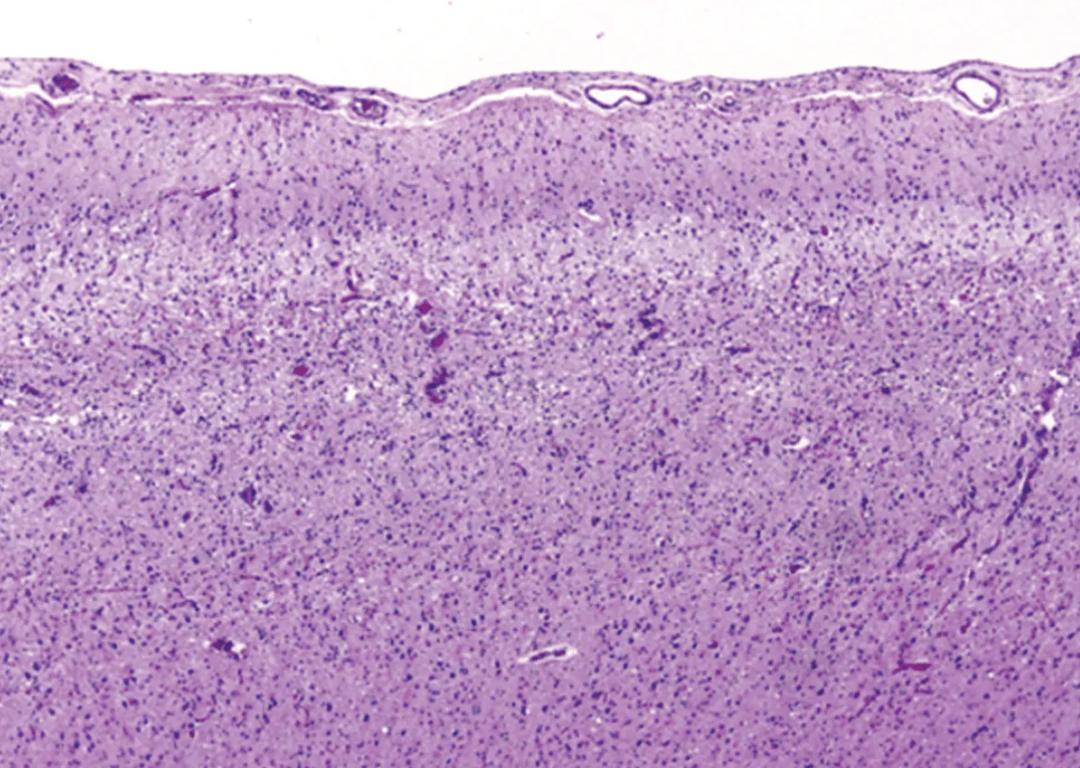 Pseudolaminar necrosis