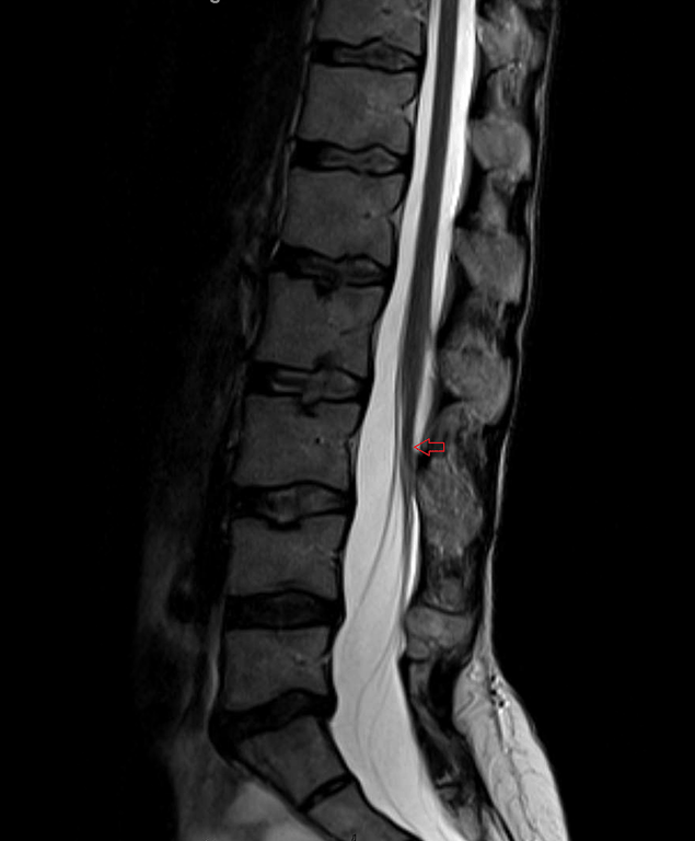 Supine T2 MRI 