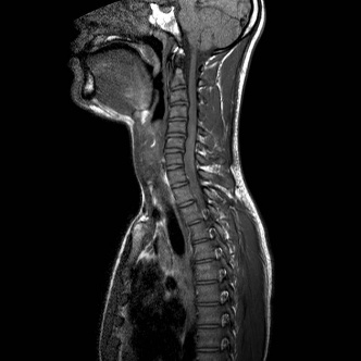 A close-up of an x-ray of a neck AI-generated content may be incorrect.