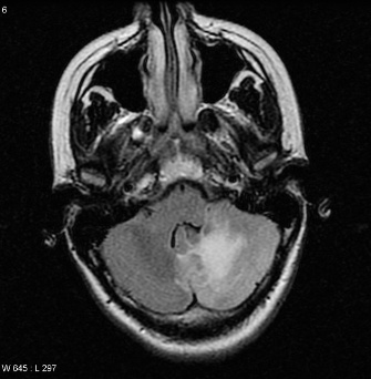 A mri scan of the brain AI-generated content may be incorrect.