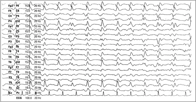 A typical EEG in sporadic CJD