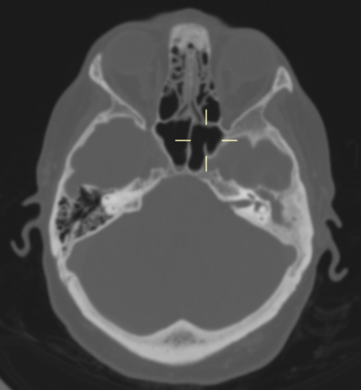Left mastoid air cell opacification