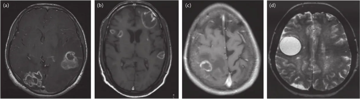MR imaging of CNS infections. (A) Cerebral tuberculoma (Helmy et al., 2011); (B) cerebral toxoplasmosis (Batra et al., 2004); (C) fungal brain abscess (Bagla et al., 2016); (D) cerebral hydatid cyst (Seckin et al., 2008).