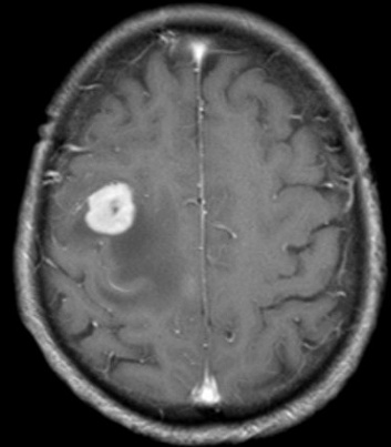 A brain scan with a white spot AI-generated content may be incorrect.