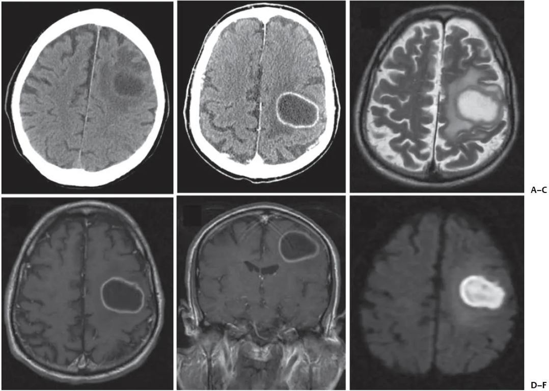 Brain abscess. (A) Nonenhanced and (B) enhanced axial computed tomographic scans demonstrate a smooth ring-enhancing lesion. (C) T2-weighted magnetic resonance image demonstrates the characteristic hypointense capsule and surrounding hyperintensity, which is the associated edema. (D, E) There is a thin enhancing rim on T1-weighted MRI with gadolinium and (F) restricted diffusion on the diffusion-weighted image.