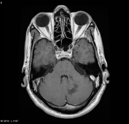 A mri of the brain AI-generated content may be incorrect.