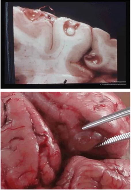 Top: Parenchymal and subarachnoid neurocysticercosis. Cut surface of brain exhibiting a cyst containing an intact scolex at the gray-white junction and exhibiting an empty cyst in the meninges. Bottom: A cysticercus removed from a pig brain.