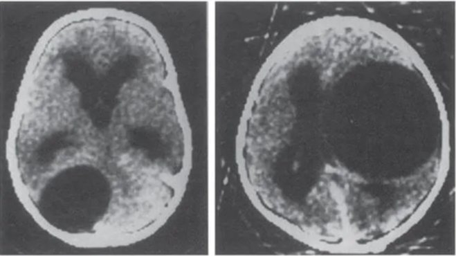 CT scan from two patients showing hydatid cysts in brain. Note sharp spherical border with lack of rim enhancement or perifo cal edema. The cyst contents have the same characteristics as CSF. 