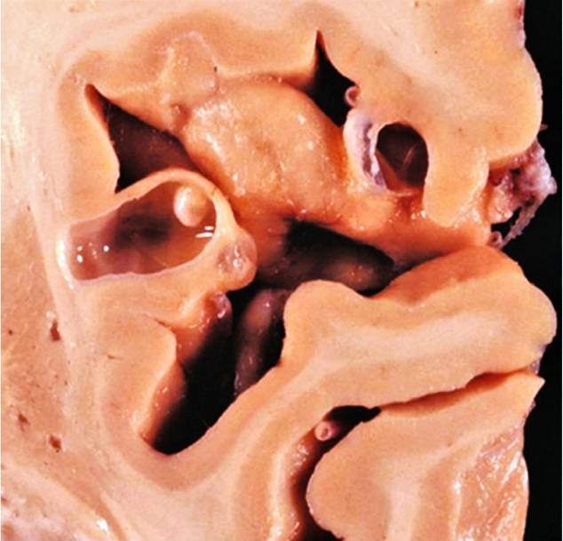 Grossly two thin-walled cysts (arrows) with scolex present in the larger cyst.