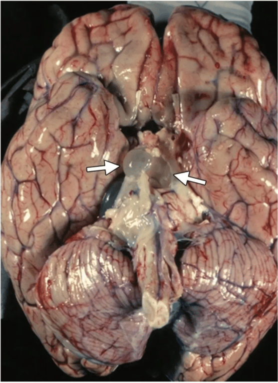 Photograph of a pathologic specimen shows cisternal neurocysticercosis in the prepontine cistern (arrows).