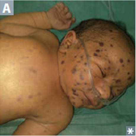 “Blueberry muffin” rash