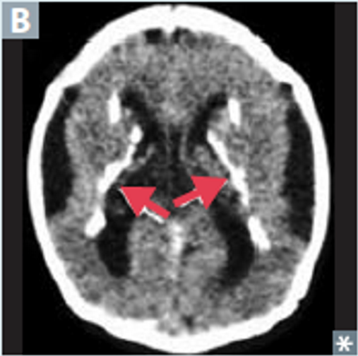 Periventricular calcifications