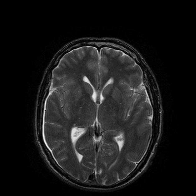 Dilated supra sagittal sinus