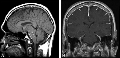 Enhancement of the pachymeninges are mainly at the apex when the brain sags down and dilates the dural vessels allowing it accumulate the contrast