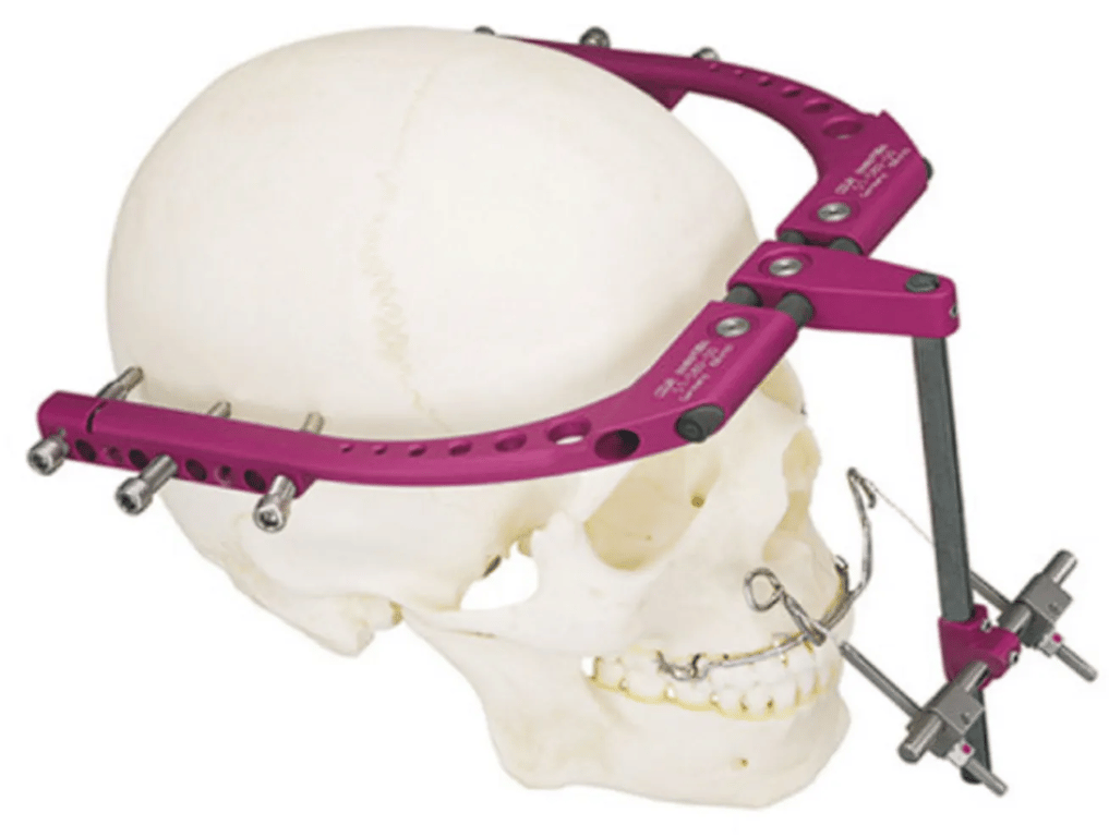 External distraction device