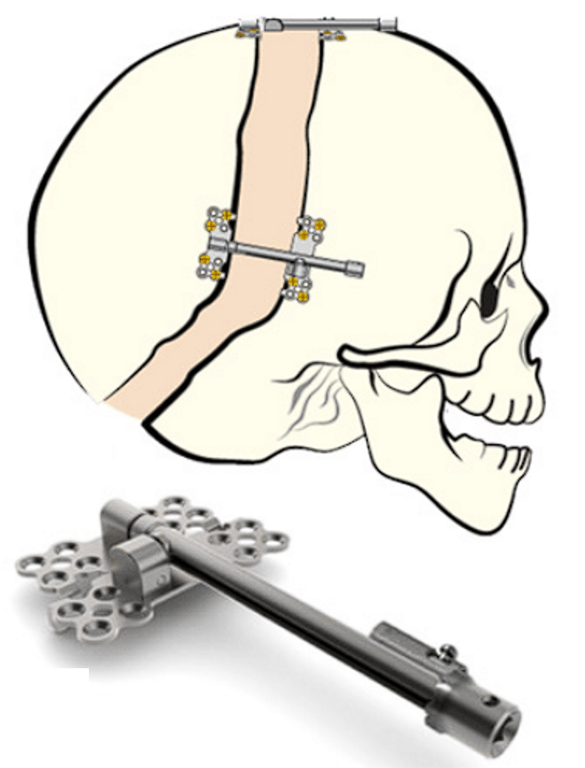 Internal distraction device