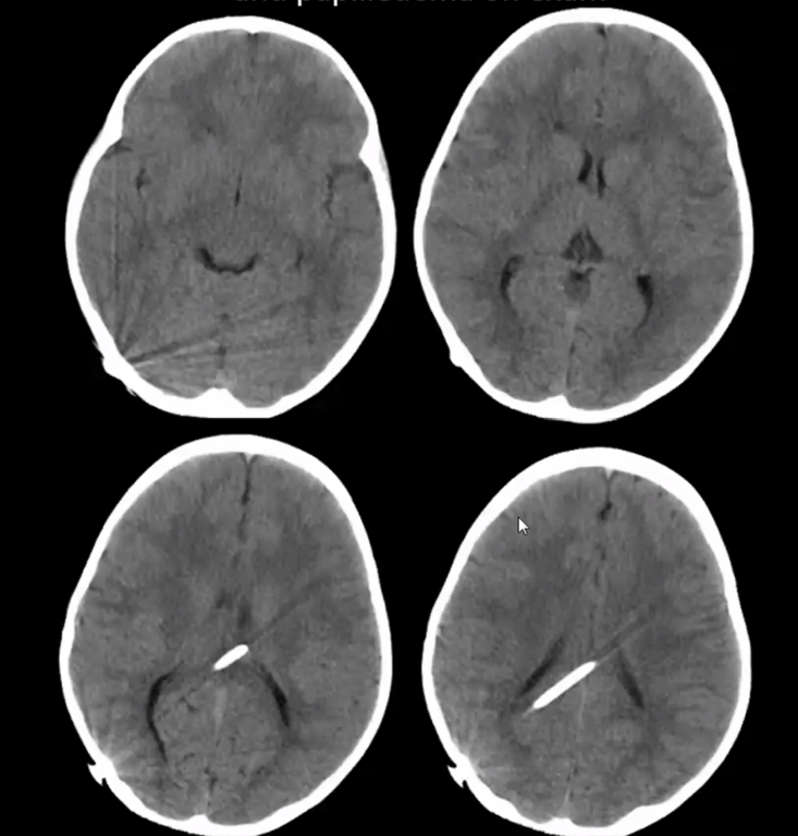 4-year-old ex-premie with perinatal IVH, biweekly episodes of HA, N/V and lethargy. Increased ICP and papilledema on exam