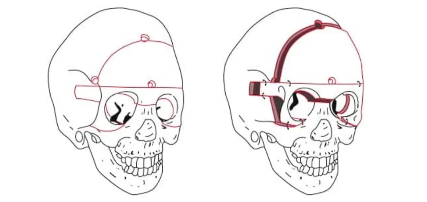 Fronto-orbital advancement (FOA)
