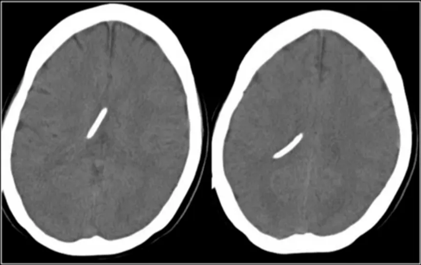 Slit-ventricle syndrome