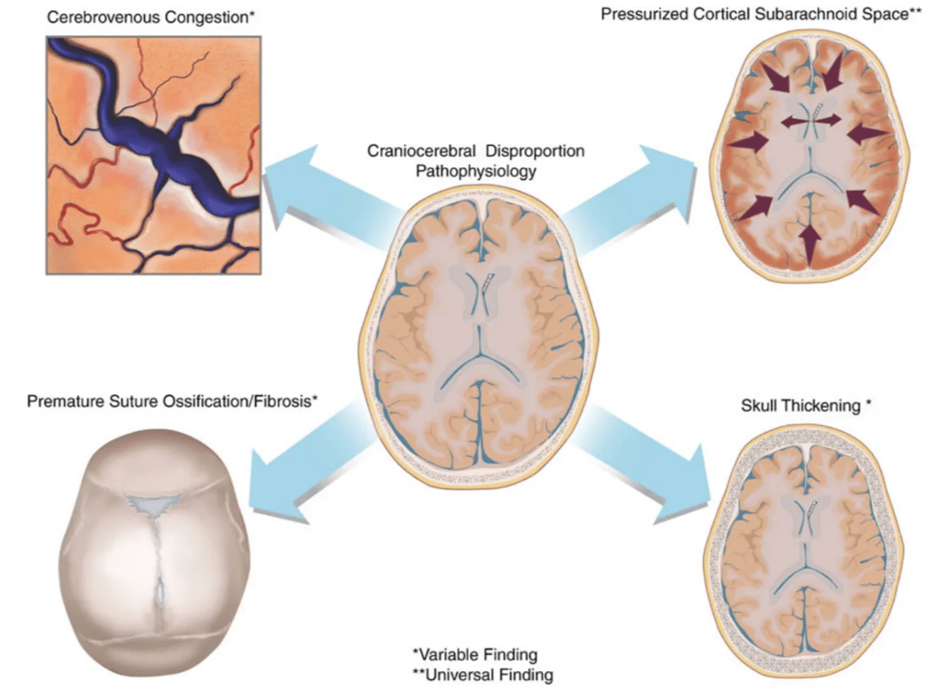 Pathophysiology of CCD