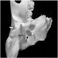 Hyrtl's Fissure : Otology & Neurotology