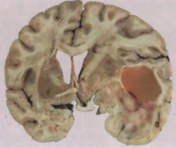 Frontotemporal anaplastic astrocytoma containing a large cyst but no macroscopically discernible necrosis. 