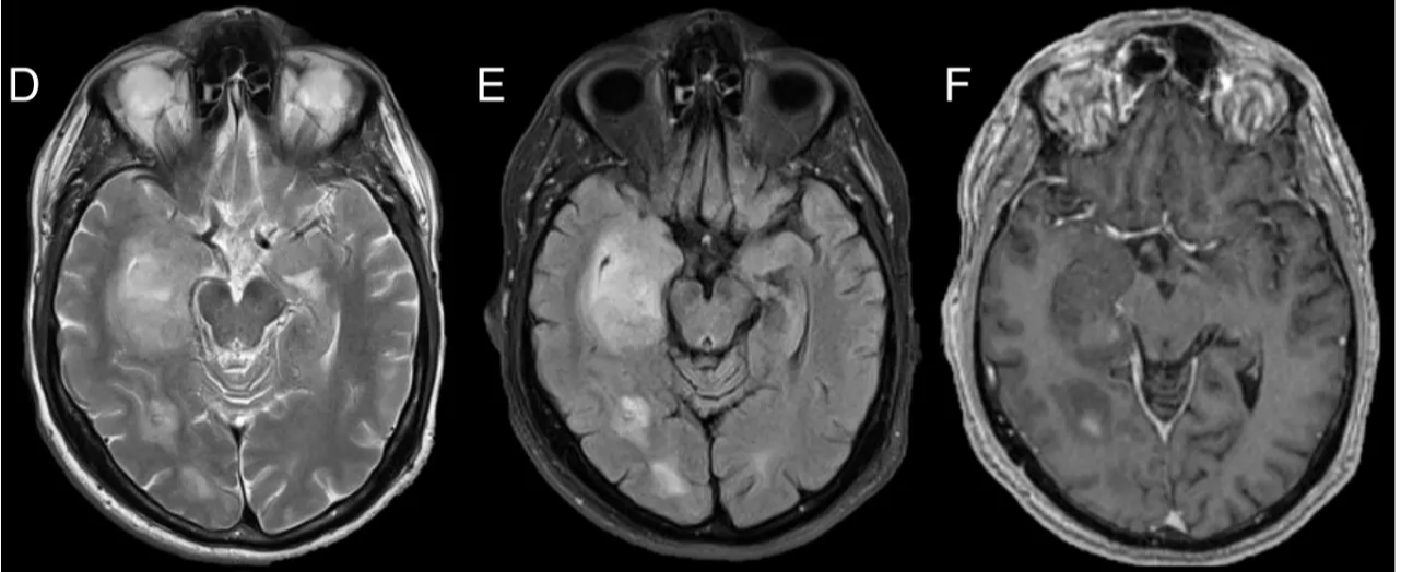 A close-up of a brain scan AI-generated content may be incorrect.