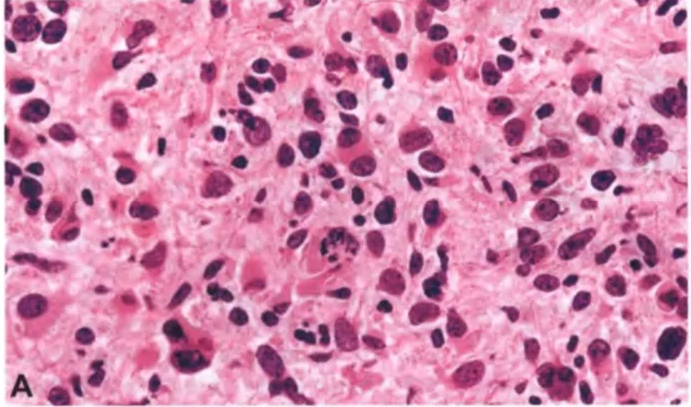 Marked nuclear pleomorphism. Note the atypical mitosis in the centre. 