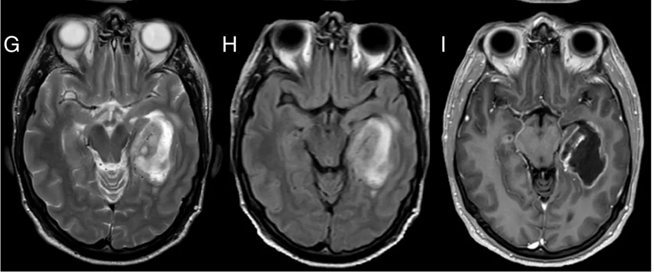 A close-up of a brain scan AI-generated content may be incorrect.