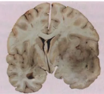 Anaplastic astrocytoma in the right frontotemporal region. Note the ill-defined borders with the adjacent brain structures and focal cysts. 