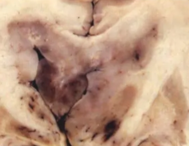 Anaplastic astrocytoma with diffuse, bilateral infiltration of the corpus callosum, the caudate nucleus, and the fornices. The fornices are grossly enlarged and show petechial haemorrhages.
