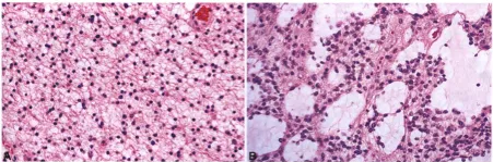 Diffuse astrocytoma. A Moderately cellular tumour composed of uniform neoplastic fibrillary astrocytic cells. B Extensive microcyst formation.