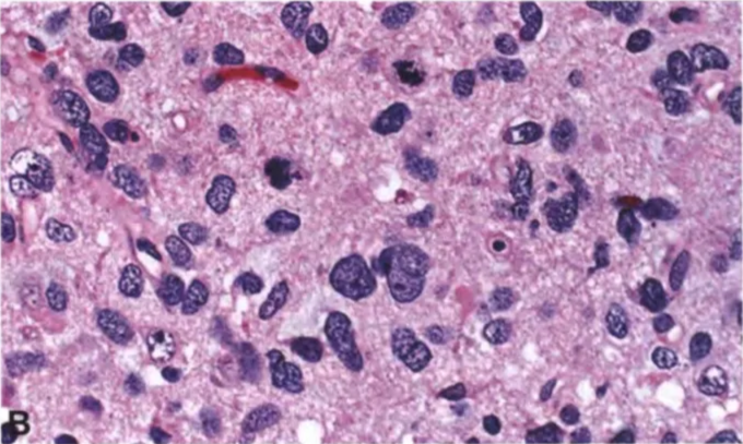 Hypercellularity and hyperchromatic, irregular, so-called naked nuclei appearing within a fibrillary background. Two mitotic figures are present.