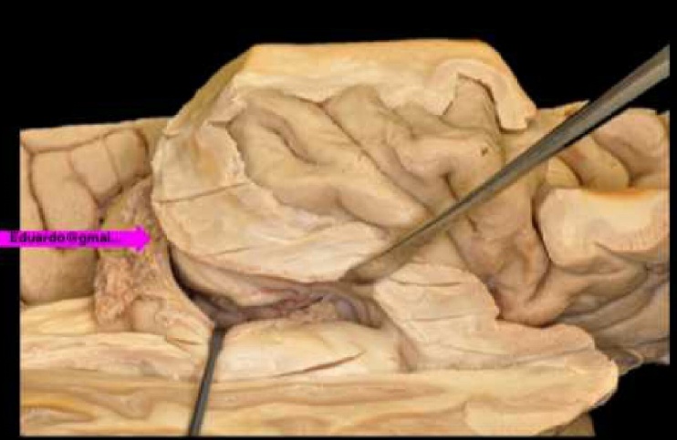 Opening of the choroidal fissure